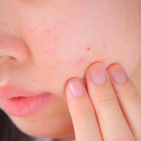 ニキビ改善フェイシャル